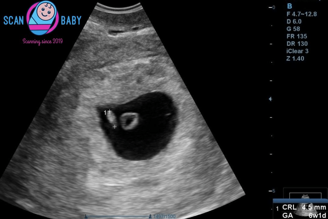 6 week scan image
