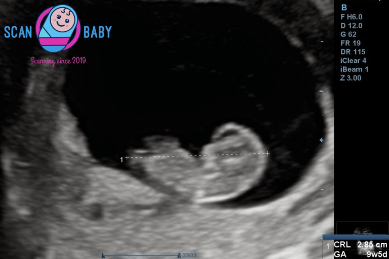 9 week scan image