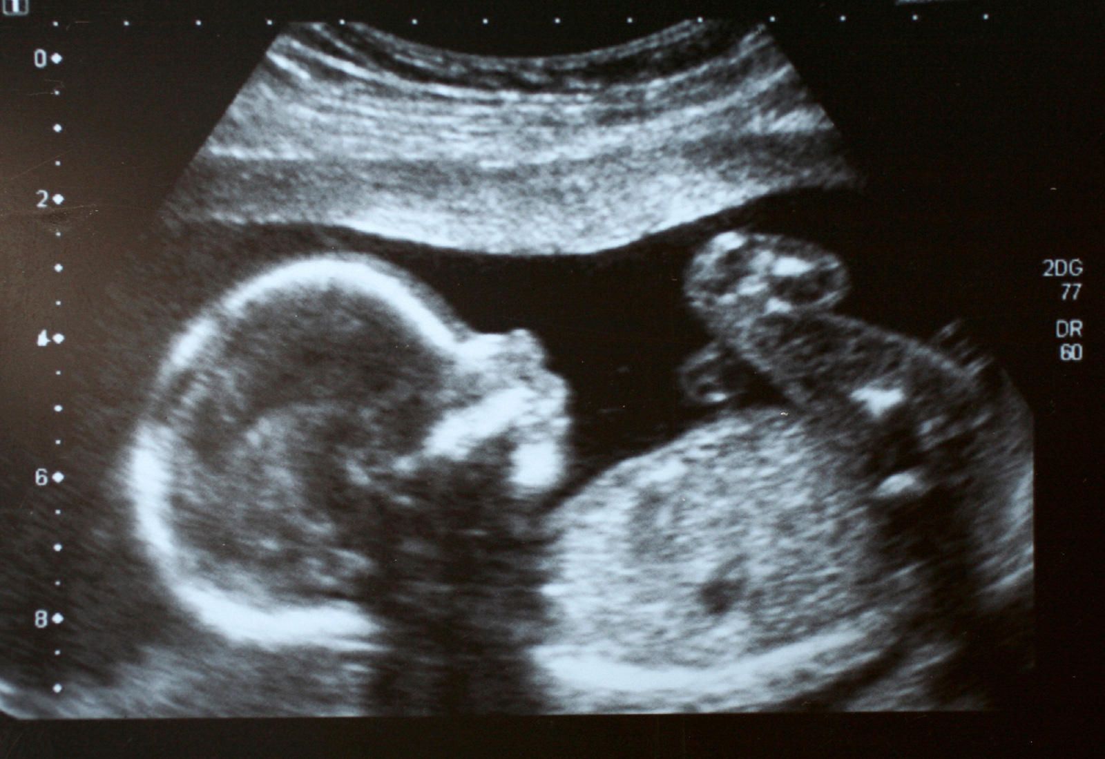 Baby scan image from Scan Baby clinic